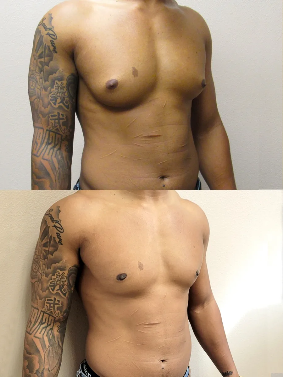 Gynecomastia patient