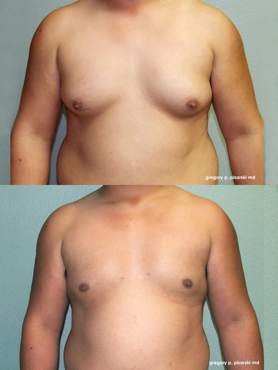 Gynecomastia patient