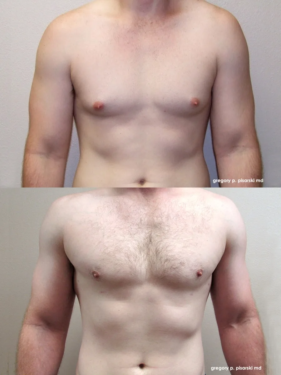 Gynecomastia patient