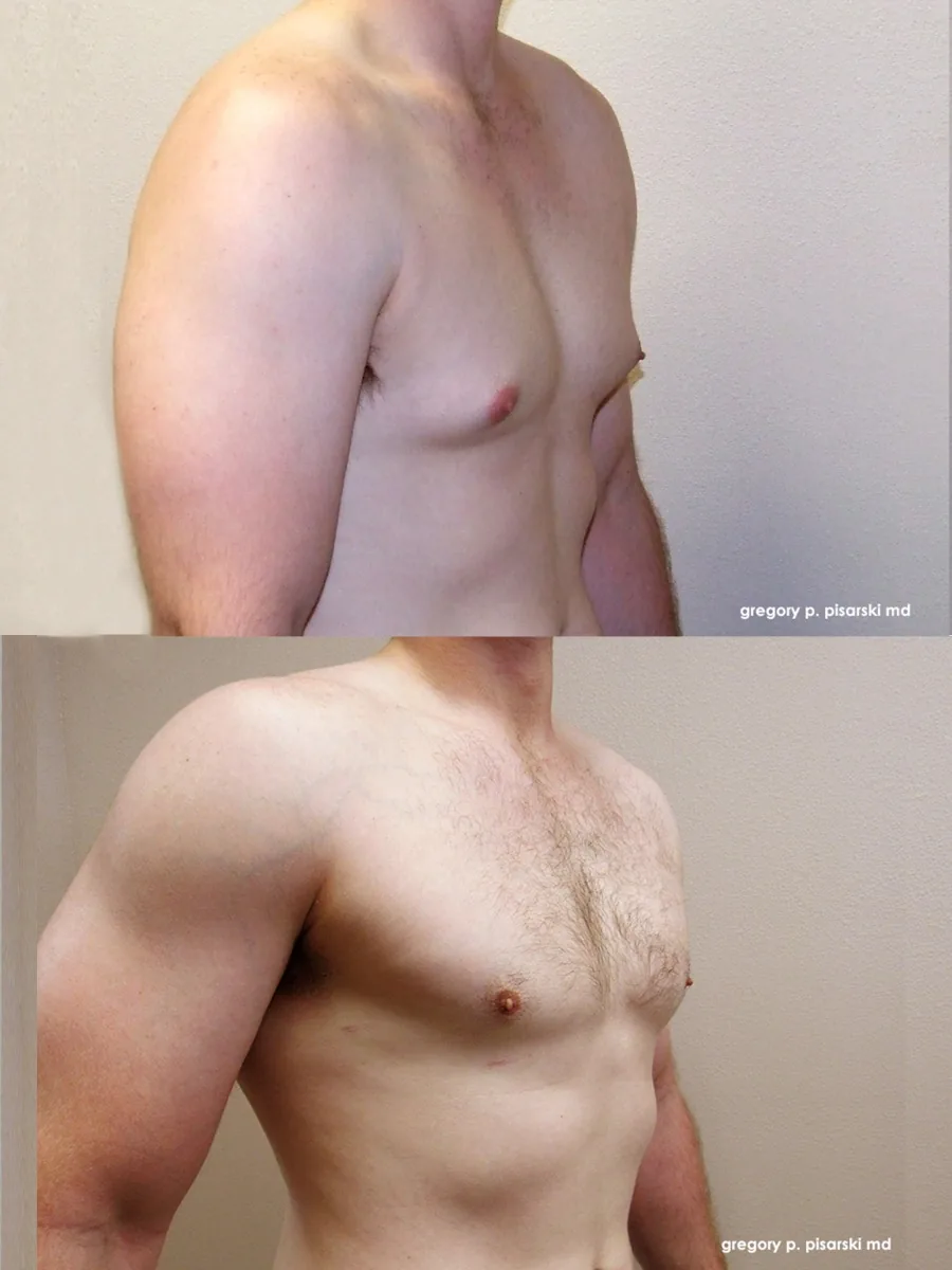 Gynecomastia patient